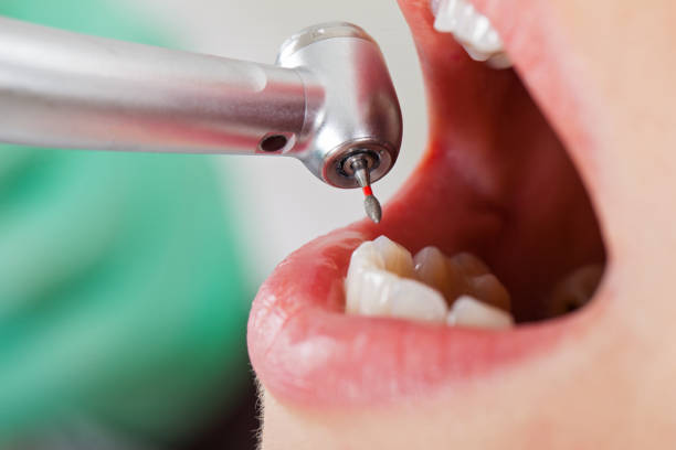 Best Emergency Tooth Extraction in Starke, FL